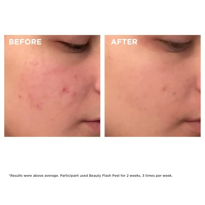 Beauty Flash Peel Face Exfoliator