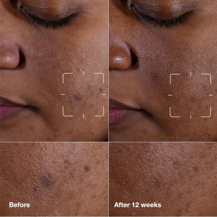 Even Better Clinical™ Dark Spot Clearing Serum