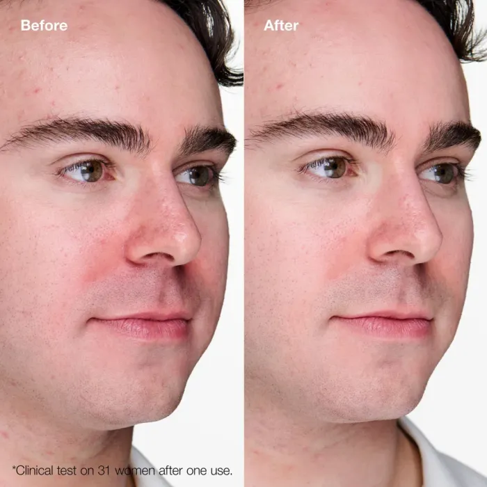 Anti-Blemish Solutions Clinical™ Advanced Clearing Gel