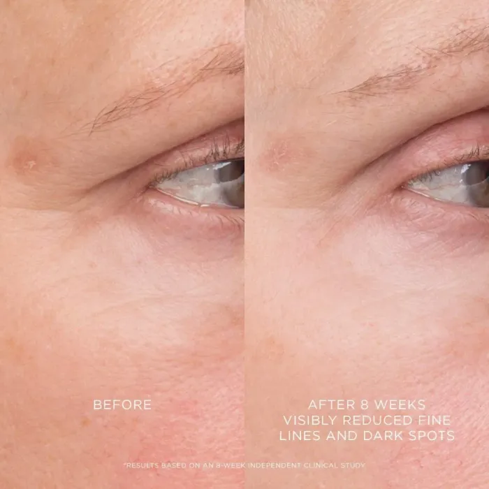 Equilibrium Resurfacing Retinoid Treatment