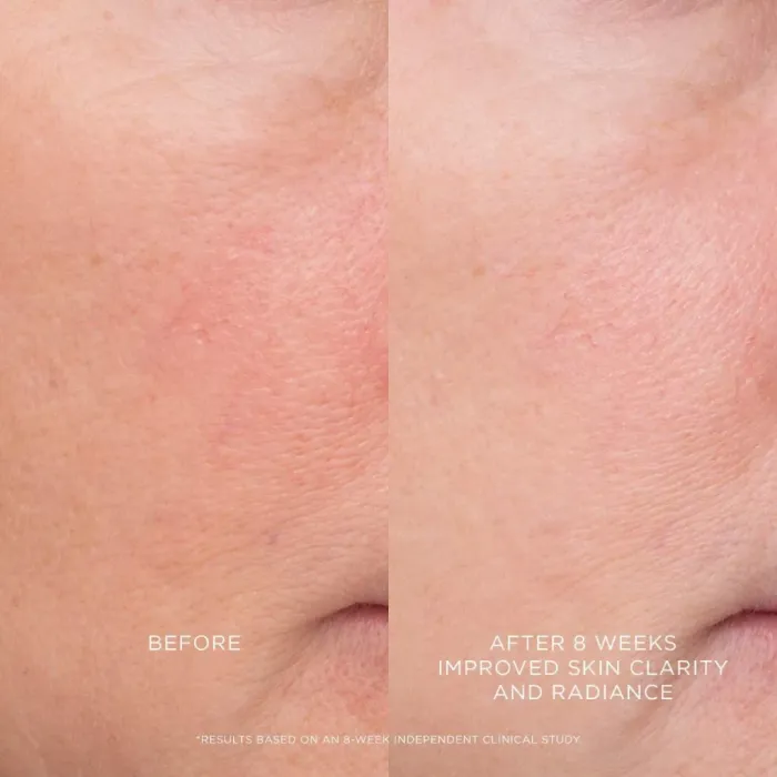 Equilibrium Resurfacing Retinoid Treatment