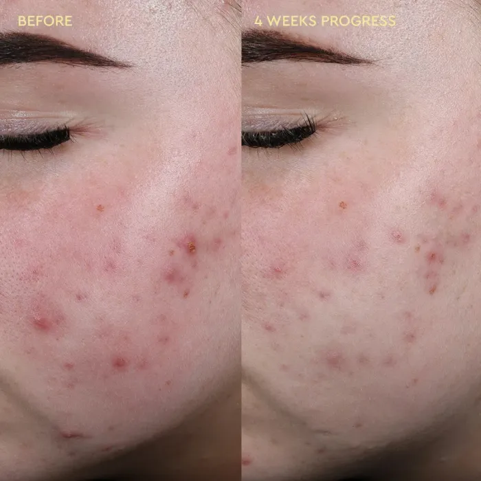Blemish Soothing Toner