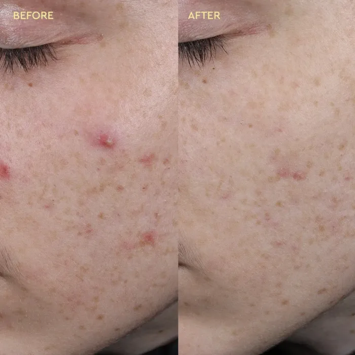 Blemish Clearing Paste